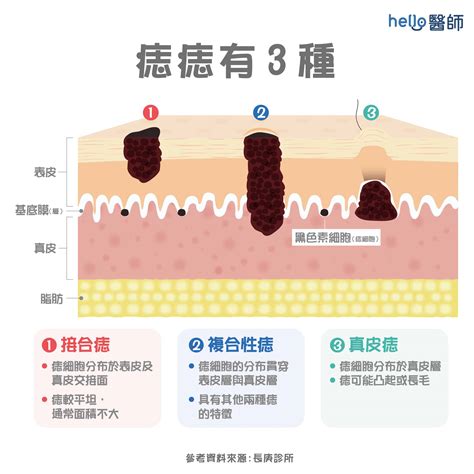 為何會長痣|為什麼臉上的痣越來越多？皮膚科醫師解析長痣原因、。